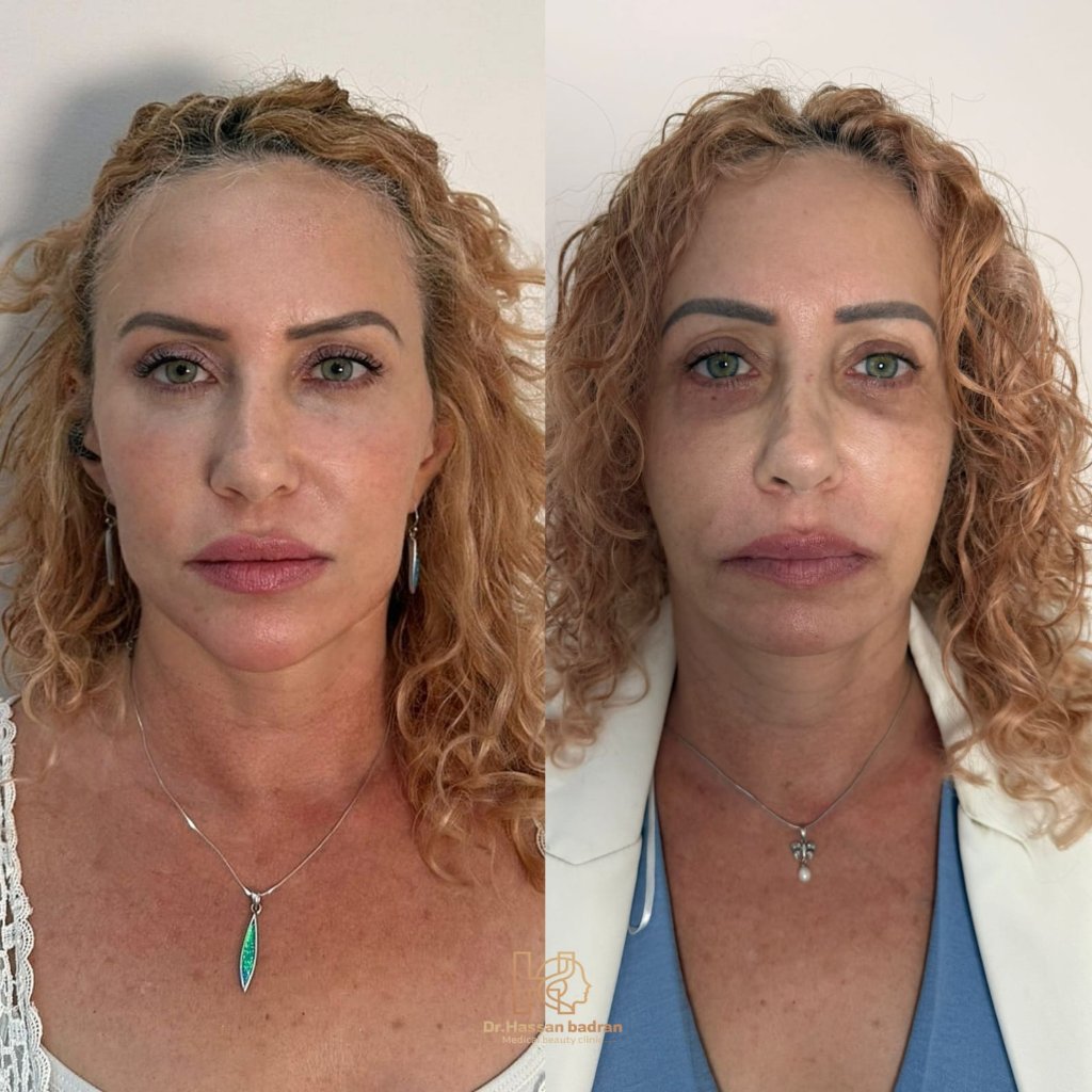 חידוש פנים